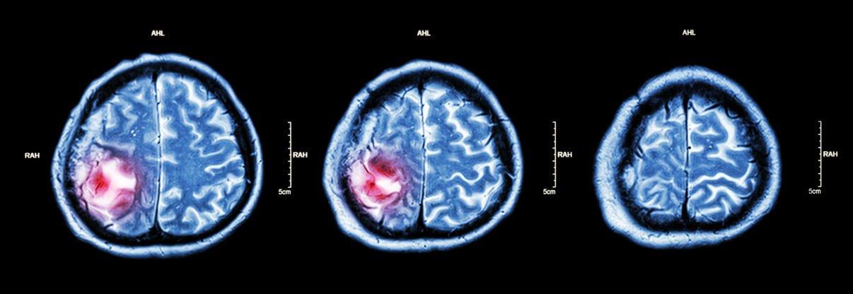Beyin Tümörü Belirtileri Nelerdir?